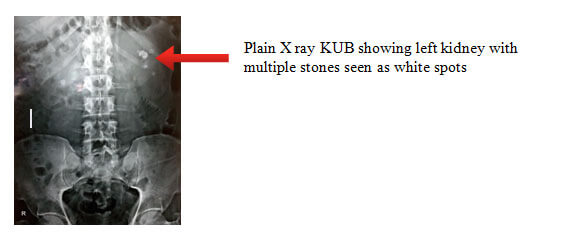 kidney stones kub xray